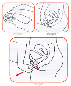 inserire la coppetta mestruale